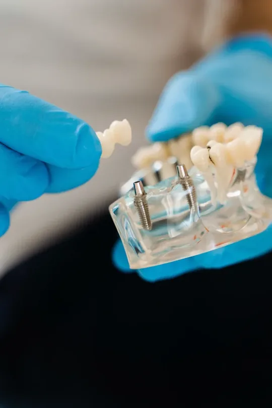 Zahnarzt zeigt an einem Modell, wie Zahnersatz auf zwei Implantaten sitzt